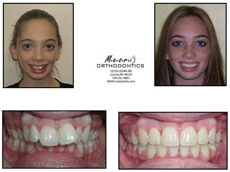 Before And After Braces Adults