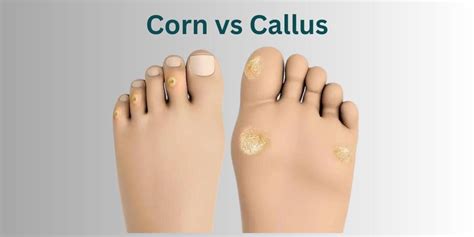 Corn vs Callus: What's the Difference?