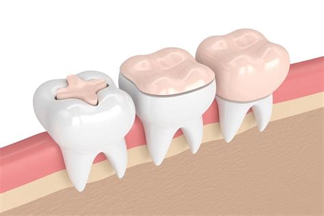 How Soon Can I Eat After Getting a Dental Inlay? - Dr. Call Dental ...