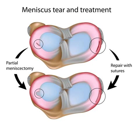 Can A Meniscus Injury Heal?