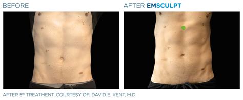 Emsculpt Before and After | Real Patient Results