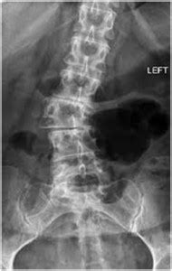 Adult Degenerative Scoliosis - Scoliosis Physiotherapy