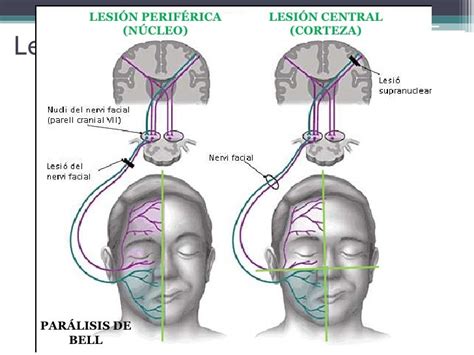 REHABILITACIÓN FÍSICA: PARÁLISIS FACIAL