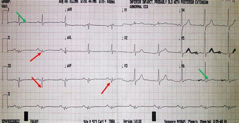 Pathological Q Wave