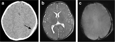 Six-month-old girl with small extra-axial hematoma. Axial non-contrast ...