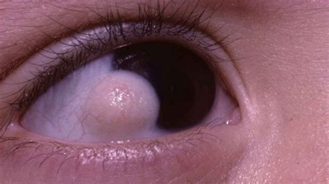 Clear Bubble On Eyeball | Renew Physical Therapy