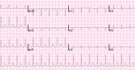 Dr. Smith's ECG Blog: Low Voltage in Precordial Leads