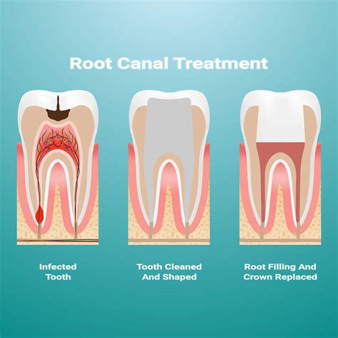 Root Canal Therapy Dallas | Barry H. Buchanan, DDS