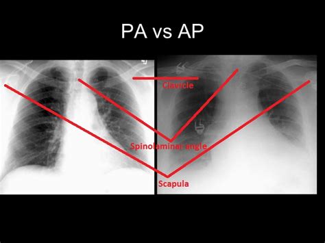 MBBS DOCTORS: Basics of Reading Chest X ray