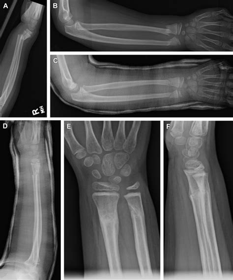 Distal Radius-Ulna Fractures in Children - Orthopedic Clinics