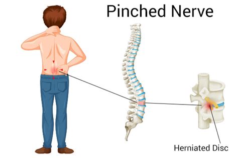 What Causes a Pinched Nerve in the Hip & How to Treat It?