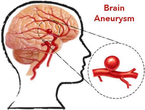 Brain Aneurysm Causes, Symptoms, Diagnosis and Treatment - Natural Health News