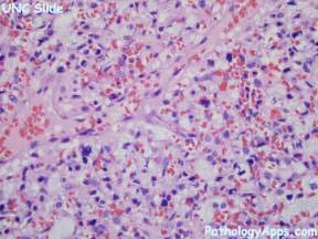 hemangioblastoma pathology