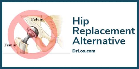 Hip Replacement Alternative - Beverly Hills, CA & Tampa Bay, FL - Dr. Lox