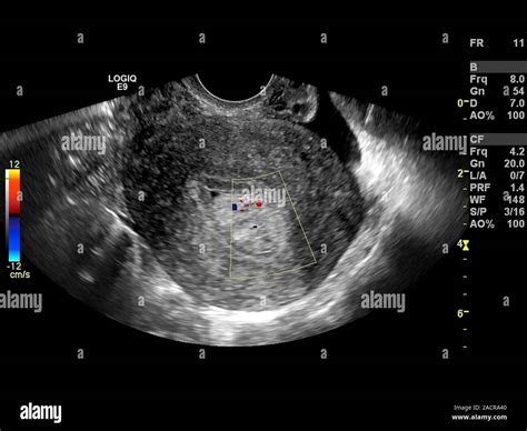 Endometrial polyp. Doppler ultrasound scan of the uterus (womb) of a 42 year old female patient ...