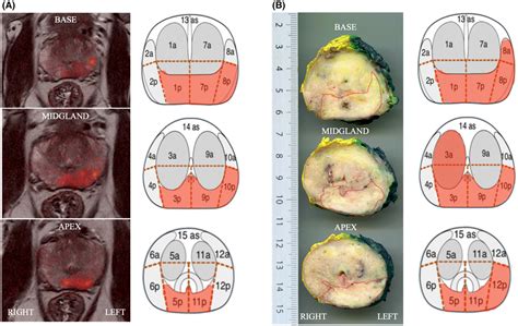 The diagnostic accuracy of multiparametric MRI for detection and ...