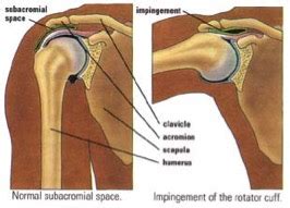 Swimmer’s Shoulder: How To Prevent The Pain - Therapydia Metairie | Mid-City | Physical Therapy ...