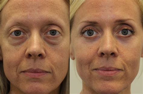 Lower Eyelid Lift (female) - Dr. Brett Kotlus