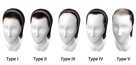 The Different Types of Hairlines - Human Hair Exim