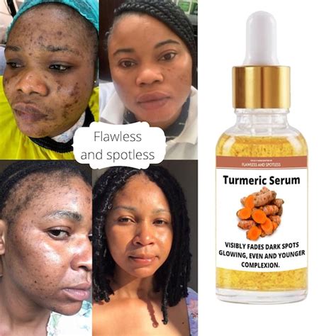 Turmeric Serum Dark Spot Remover Glowing Flawless Skin Dark - Etsy