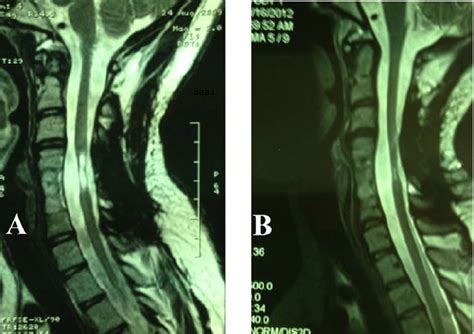 A: pre-operative T2 weighted MRI of a patient with cervical spinal cord ...