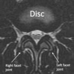 MRI Lumbar Spine Anatomy - Rocky Mountain Brain and Spine Institute