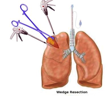 Lung Segmentectomy and Limited Pulmonary Resection Technique ...