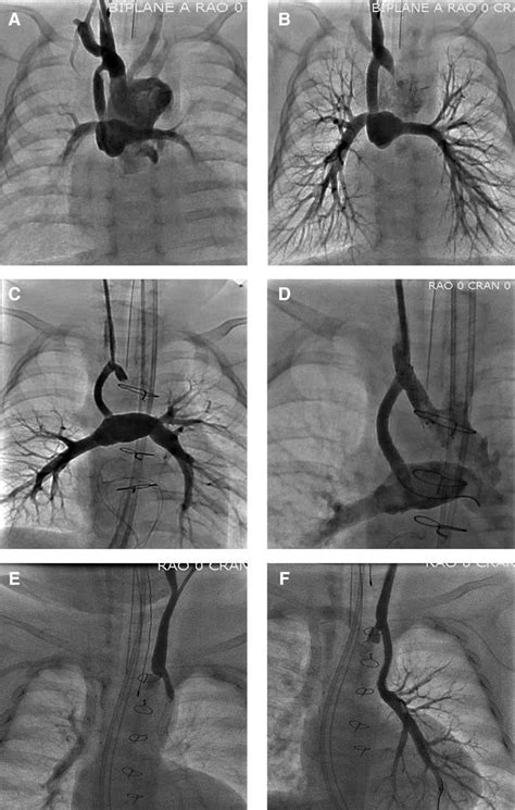 Blalock-Taussig (BT) shunt stenting. This figure demonstrates 3 ...