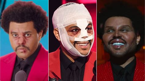 Is The Weeknd's Plastic Surgery Real? Photos, Details