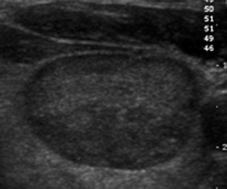 Transverse US image of follicular adenoma in a 34-year-old woman shows... | Download Scientific ...