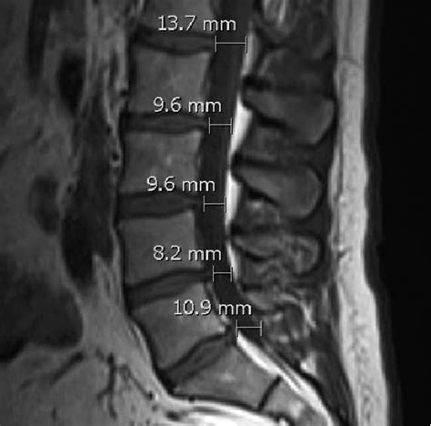 Anteroposterior diameter of the spinal canal measured on MRI (axial T2 ...