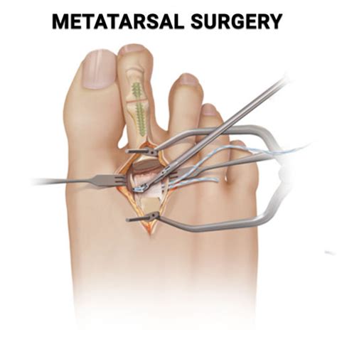 Metatarsal Surgery - Premier Podiatry: Velimir Petkov, DPM: Podiatrists: Clifton, NJ