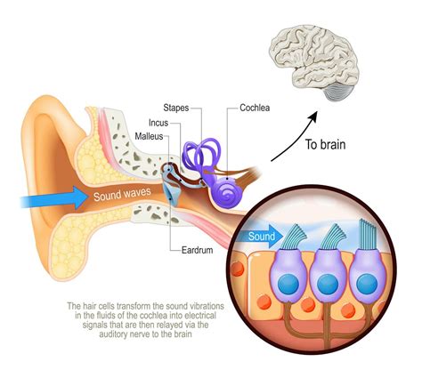 Cochlear implants can bring the experience of sound to those with ...