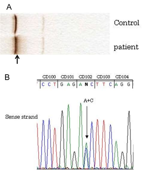 Figure.A: Hb electrophoresis (isoelectric focusing) of the patient and... | Download Scientific ...