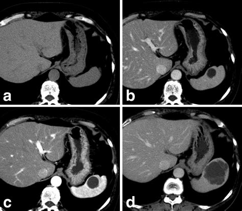 CT findings. (a) Non-enhanced CT performed in June 2012 showed no ...