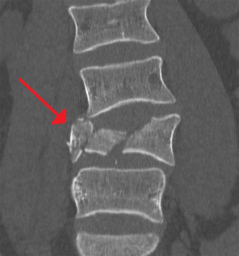 Burst Fracture Settlements (Car Accidents, Falls and More)