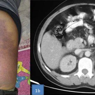 (PDF) Perplexing Etiology of Grey Turner Sign -Perinephric Hematoma in Dengue