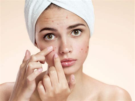 Healthy Habits to Prevent Acne: 5 Daily Habits that Can Prevent Acne