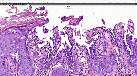 Acantholytic acanthoma, Phillip McKee, Antonina Kalmykova, CSD Health ...