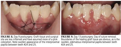 Healing Progression of the Free Gingival Graft - Decisions in Dentistry