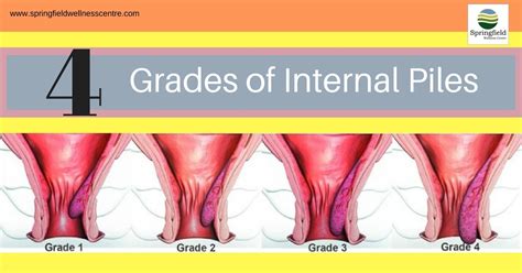 More About Grades of Internal Piles - Dr Maran - Springfield Wellness Centre | Bariatric and ...