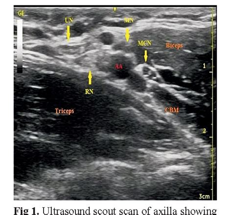 Axillary Nerve Block