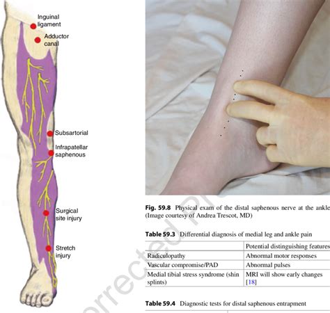 Posterior Tibial Nerve Entrapment