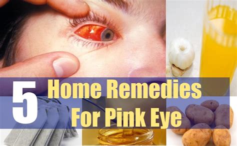 5 Home Remedies For Pink Eye – Natural Home Remedies & Supplements