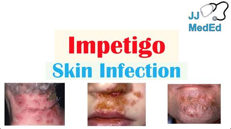 Impetigo On Lips Pictures | Lipstutorial.org