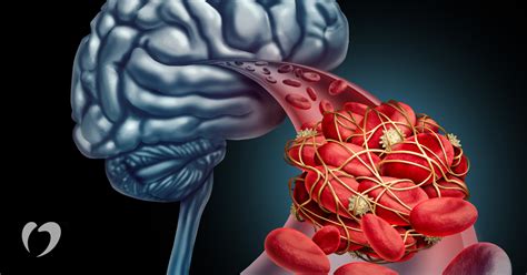 What is a transient ischemic attack or TIA? | Oklahoma Heart Hospital