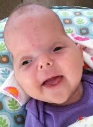 Craniosynostosis | Australia| PDF | PPT| Case Reports | Symptoms | Treatment