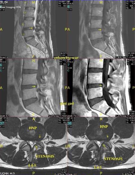 Lumbar Radiculopathy - Lumbar Center