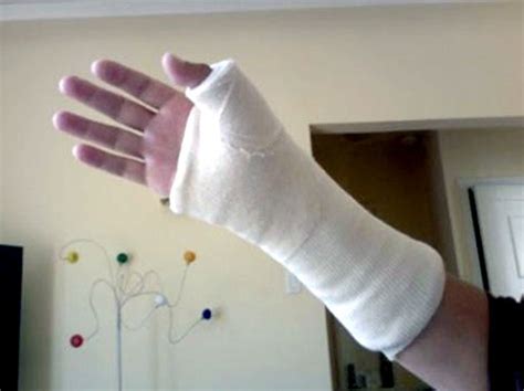 Cast Kit - Short Arm - Plaster - A-1 Medical Integration