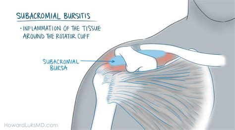 What Is Bursitis Shoulder